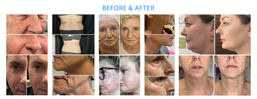 Dermafuse 5D HIFU-Pro Dermafuse 5D HIFU-Pro
