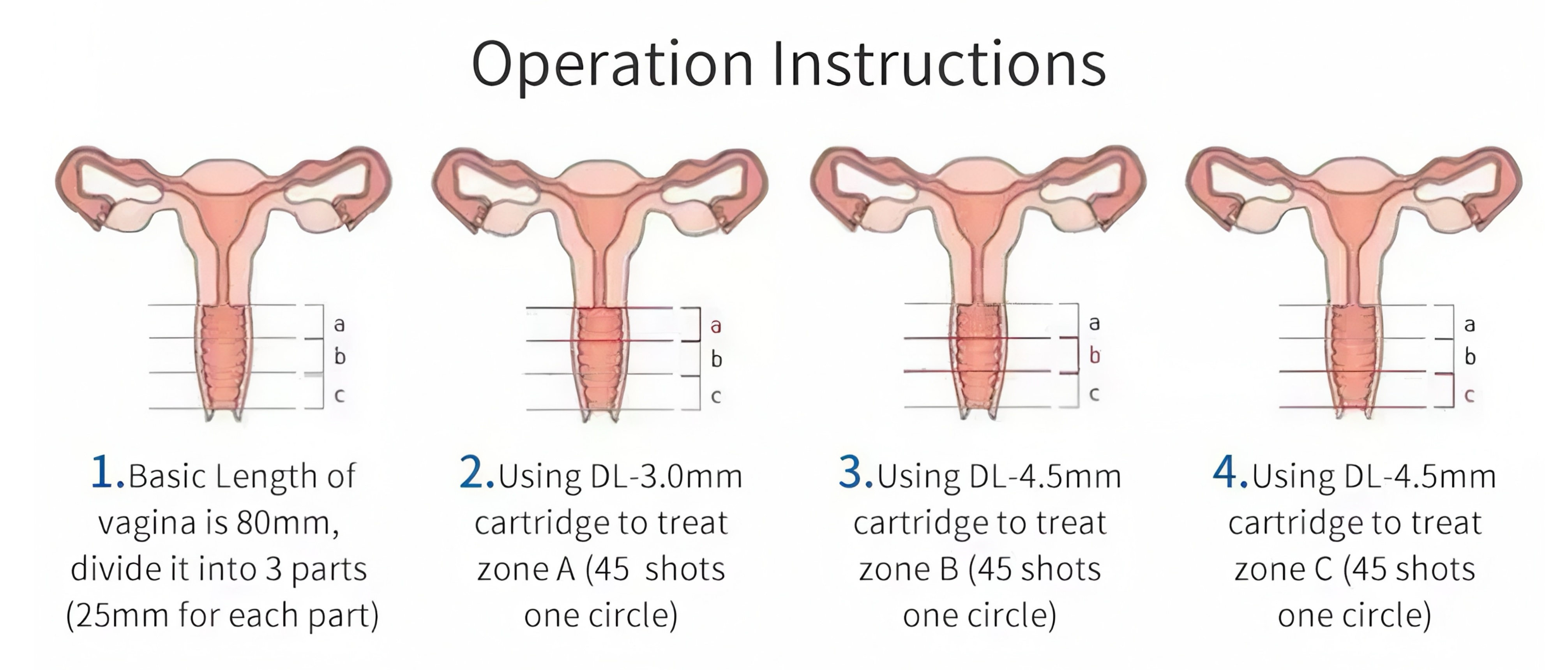 Dermafuse HIFU Vaginal Tightening System