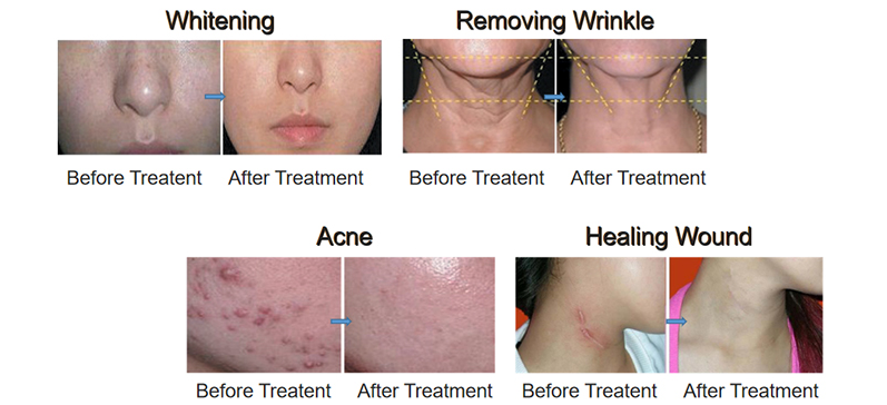 Dermafuse PhotonFuse LED Therapy System