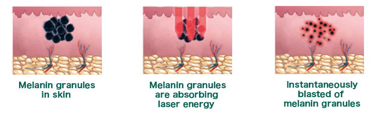 Q-Switched Nd:YAG Laser System Q-Switched Nd:YAG Laser System