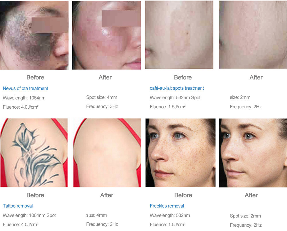 Q-Switched Nd:YAG Laser System Q-Switched Nd:YAG Laser System