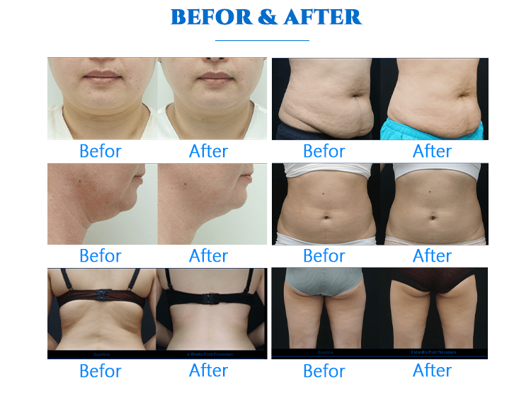 CryoFuse 360°Body Contouring machine