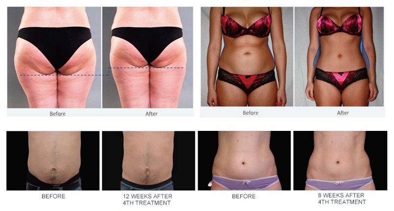 FuseSculpt HIFEM Muscle build & Fat reduction