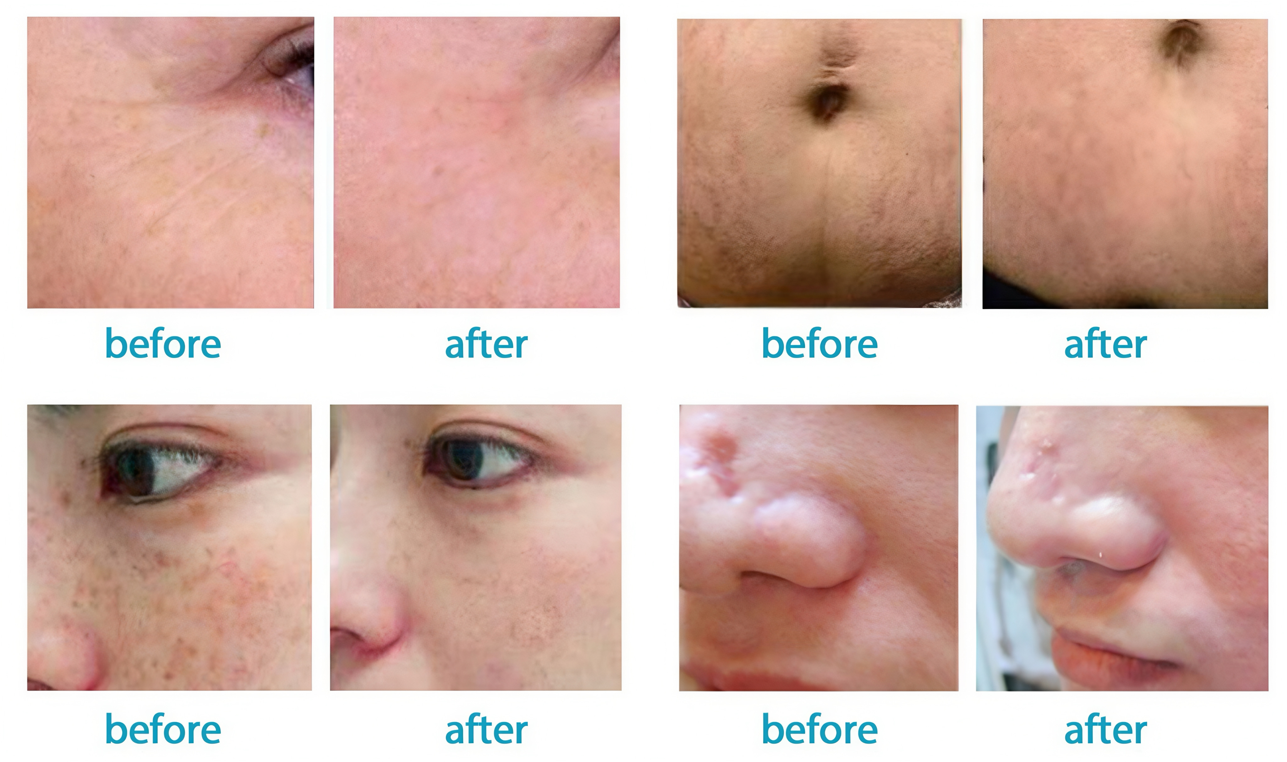 FDA-Cleared Fractional CO2 Laser Technology