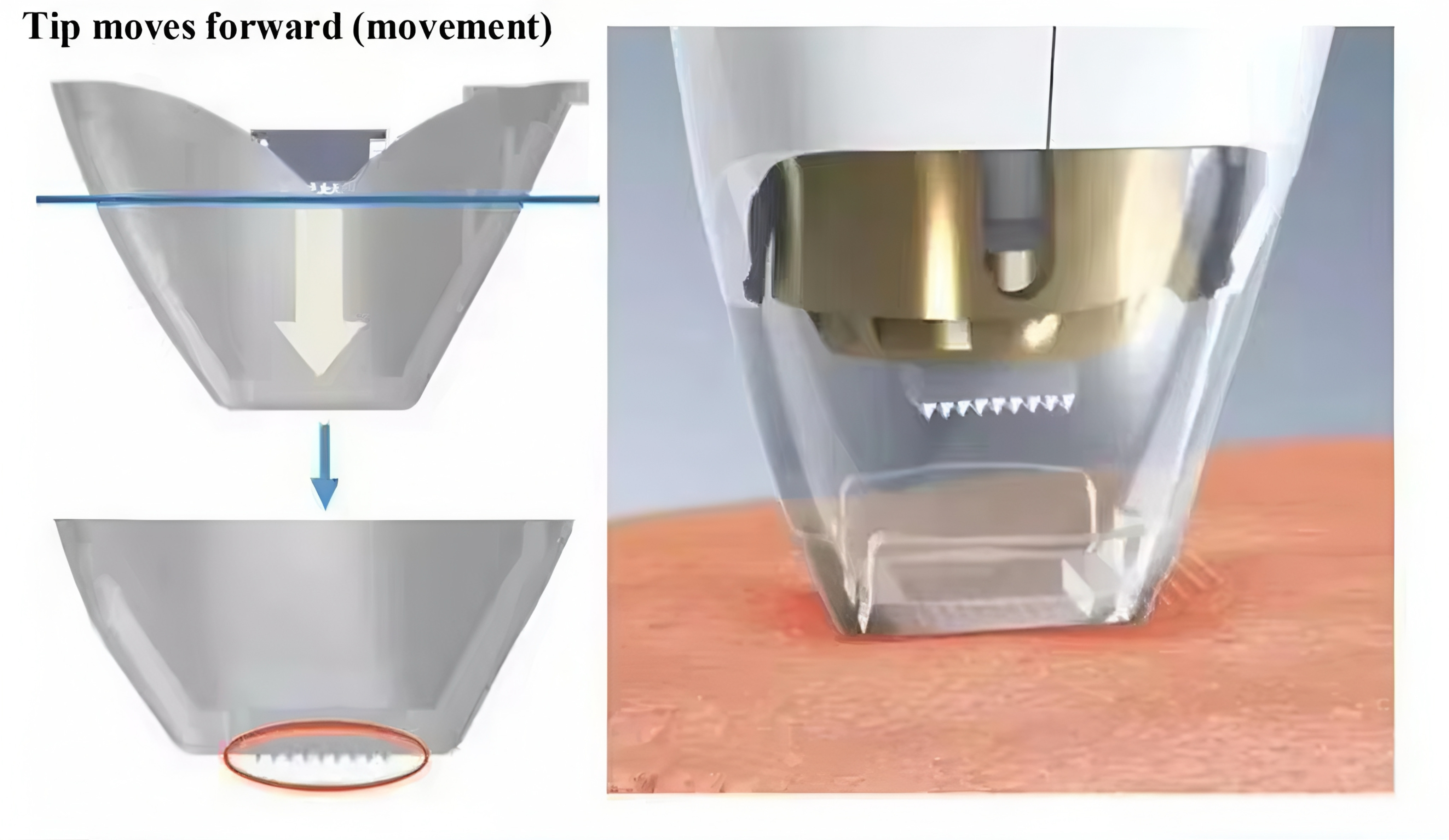 Dermatix – Revolutionary Skin Rejuvenation Technology