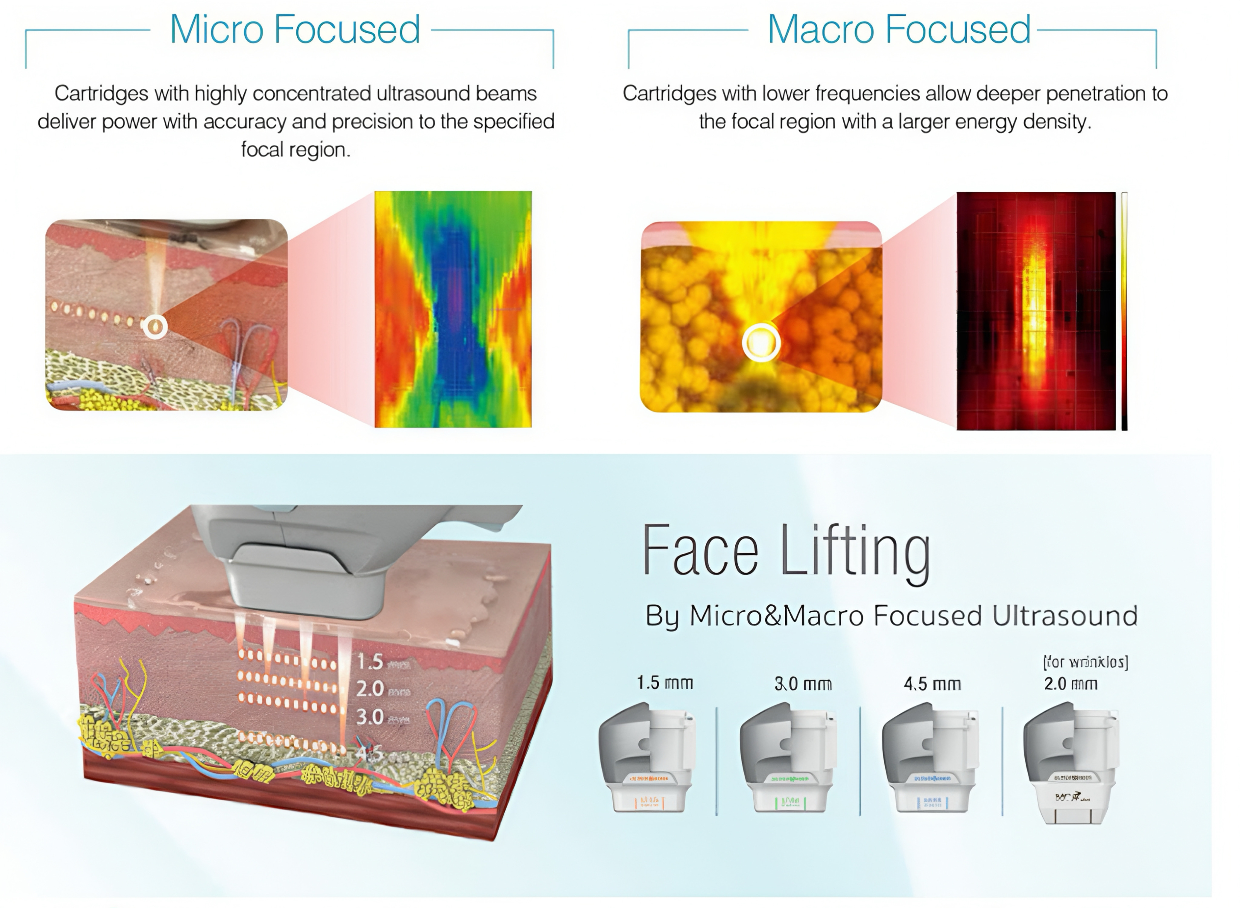 Dermafuse 7D HIFU